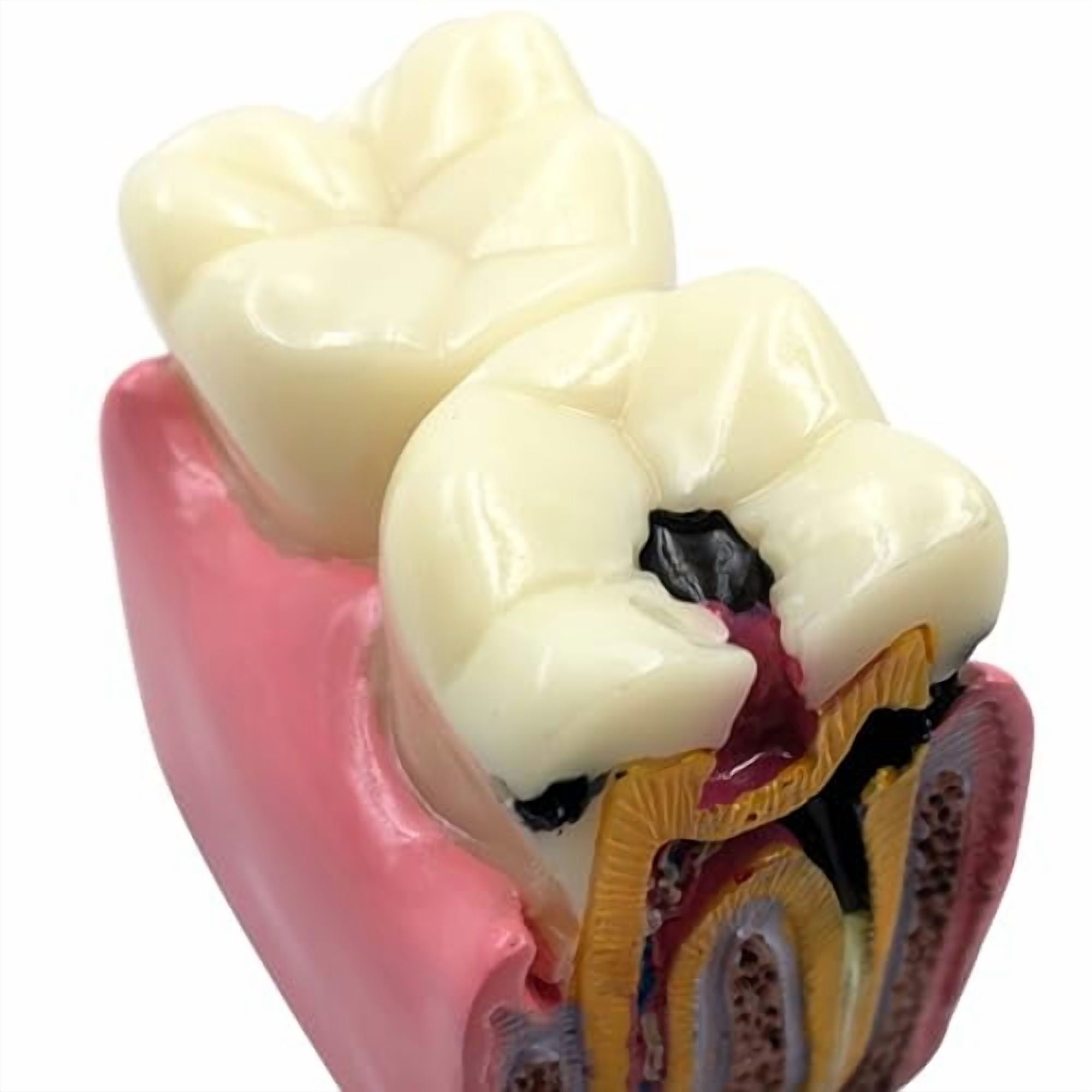 8 Times Dental Caries Teeth Model, Dental Education Demonstration Tooth ...