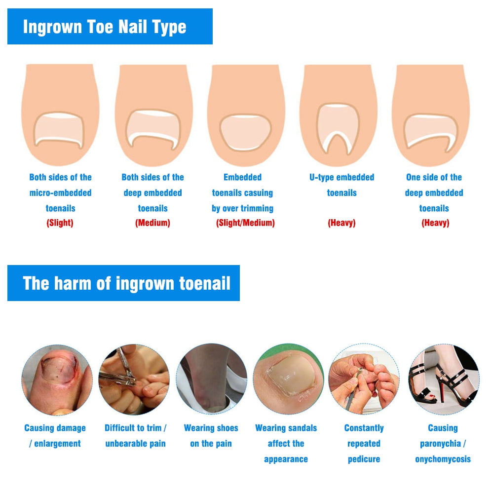 ANGGREK 10Pcs Transparent Toenail Correction Patches for Ingrown Nail