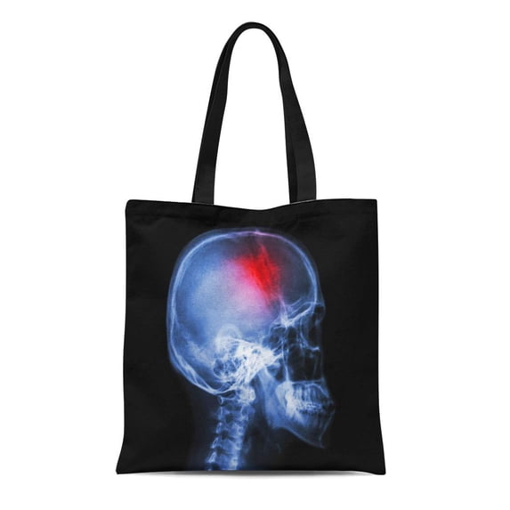 ASHLEIGH Canvas Tote Bag Stroke Film X Ray Skull Lateral View Show Human Reusable Shoulder Grocery Shopping Bags Handbag
