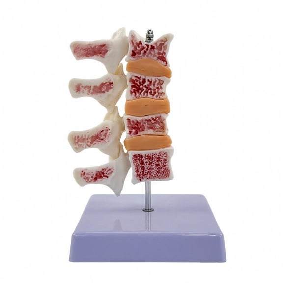 Abbraccia Osteoporosis Spine Model with Red Speckled Porous Vertebrae and Orange Discs for Classroom Education