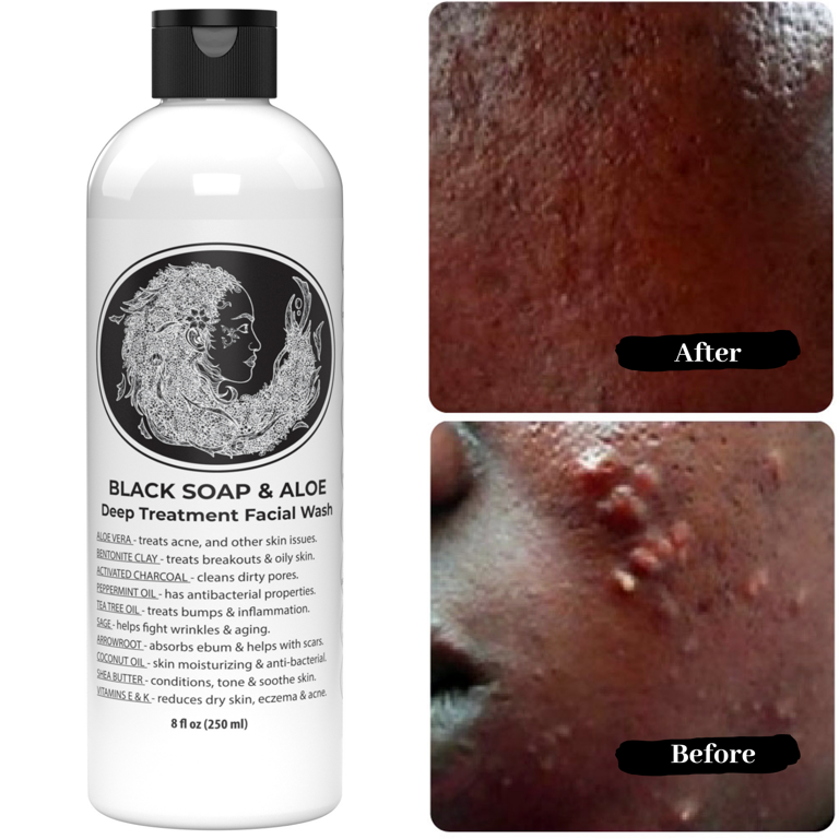 Acne Antibacterial Soap Discounted Price