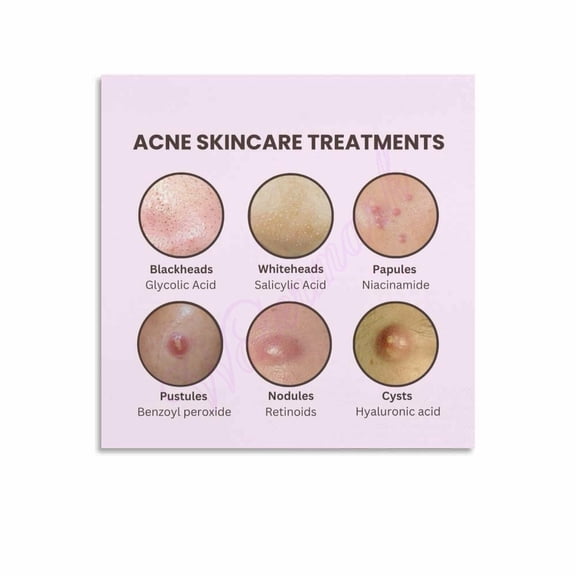 Acne Face Map Beauty Clinic Skin Analysis Posters4 Canvas Painting Wall Art Poster for Bedroom Living Room Decor