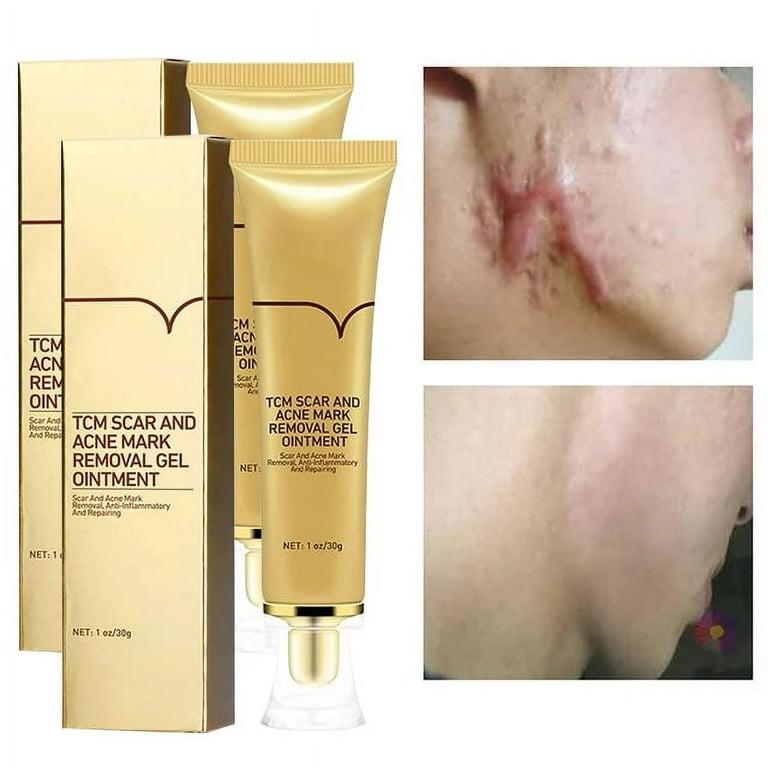 Acne Scar Removal Cream Scar Cream Stretch Marks Face Skin Cream Shrink Pores Gel Fade Scar Marks Fast absorption for Face Keloids C Section Burns Injuries 2pcs Walmart