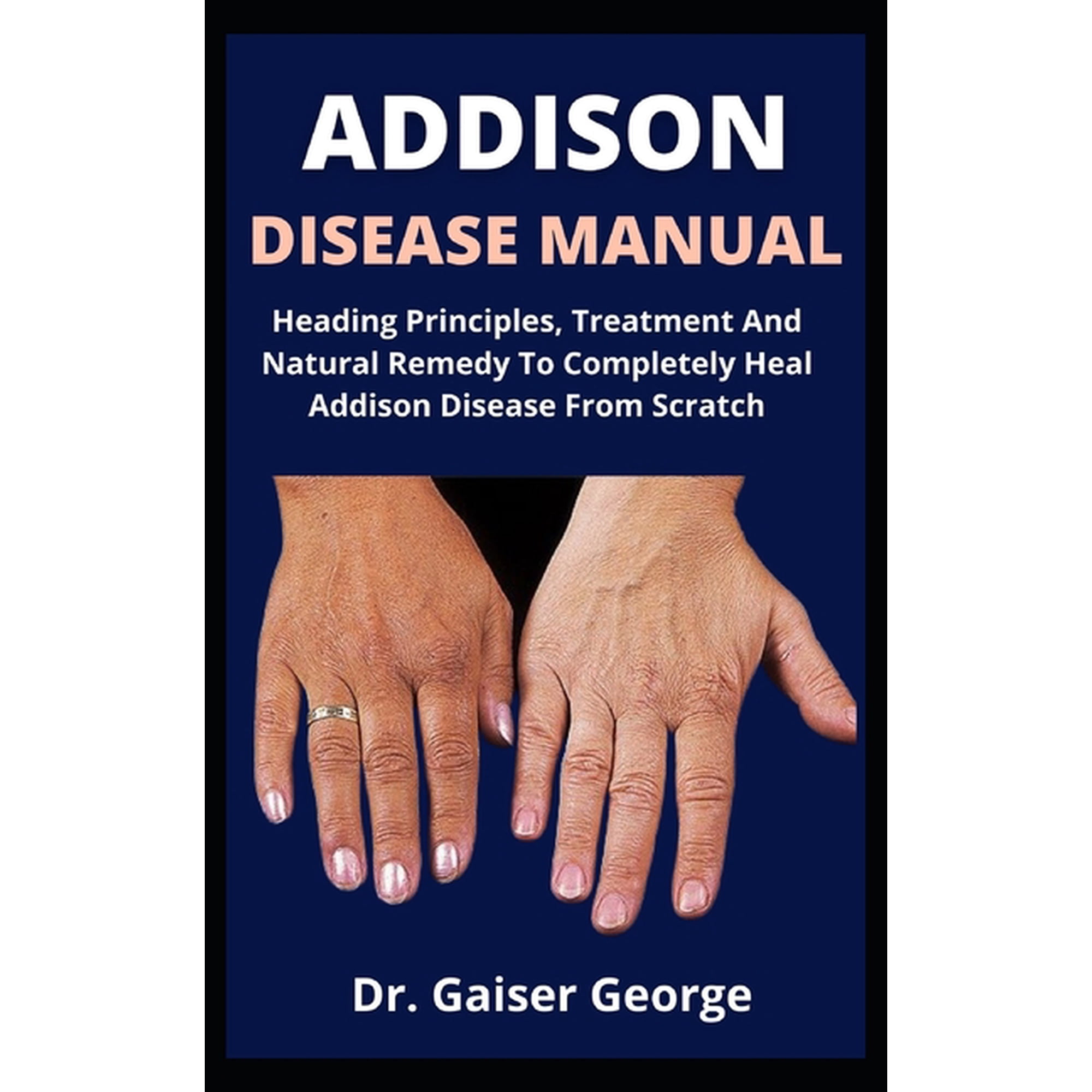 Addisons Disease