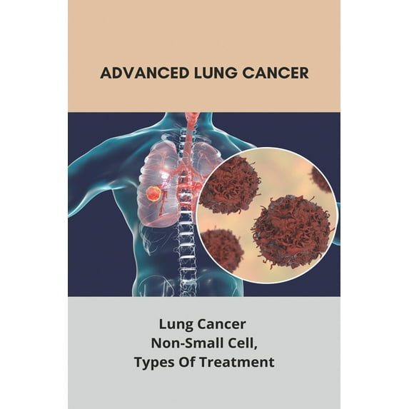 Advanced Lung Cancer: Lung Cancer - Non-Small Cell, Types Of Treatment: Lung Cancer Survival Rate (Paperback)