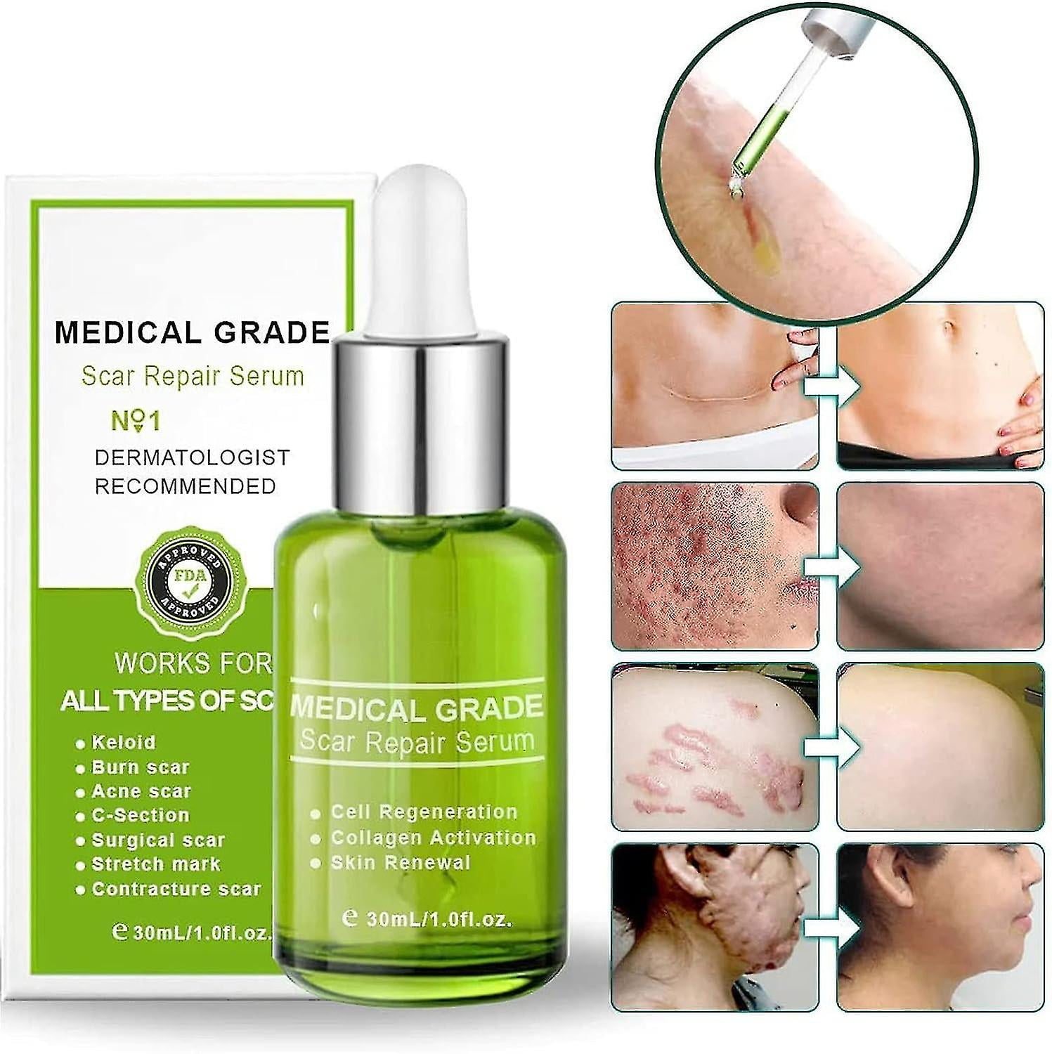 Advanced Scar Repair Serum, Scar Remove Essence For Csection, Keloids
