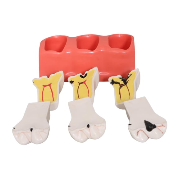 Almencla Sumulation Decay Tooth Model Demonstration Removable 4 Times Teaching Aid Educational Materials for Props Teacher Study Tool