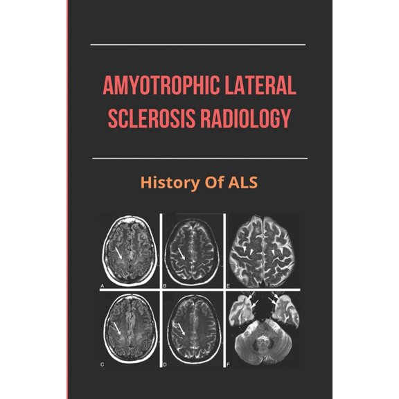 Amyotrophic Lateral Sclerosis Radiology : History Of ALS: Amyotrophic Lateral Sclerosis Symptoms (Paperback)