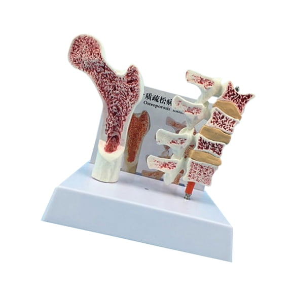 Anatomical Osteoporosia Vertebrae Model for Anatomy Education & Patient Spine Study