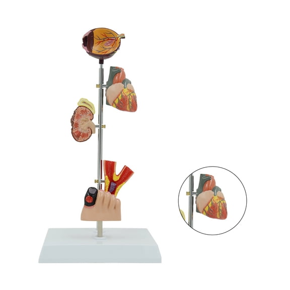 Anatomical Pathological Kidney Model, Pathology Demonstration Anatomy Model Human Kidney Blood Vessel Model
