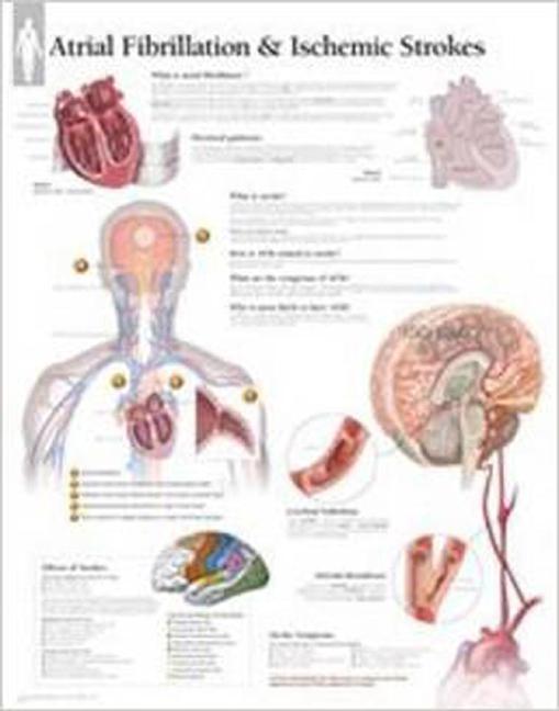 Anatomical Wall Charts: Atrial Fib & Ischemic Strokes Wall Chart (Wallchart)