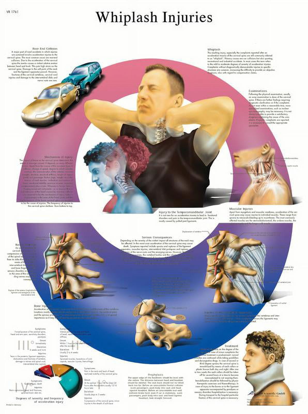 Anatomical chart: whiplash, paper