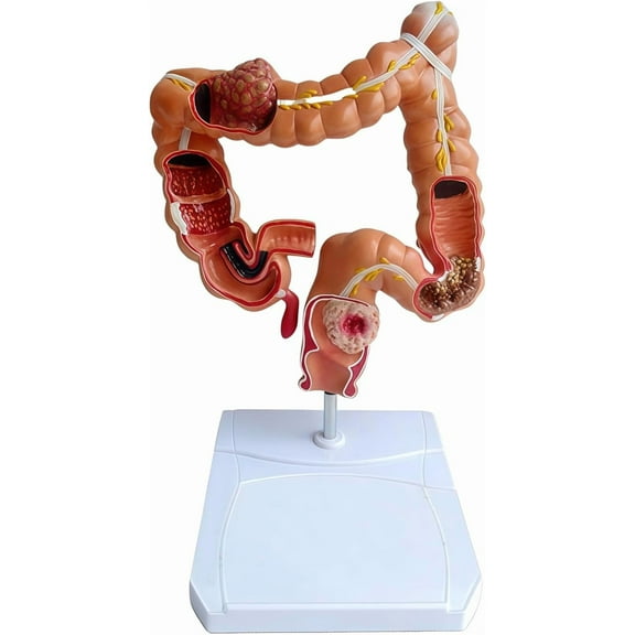 Anatomy and Physiology Study Tools: Human Anatomy Model, 1:1 Life-Size 3D Colon Pathology Model, Digestive System Model Anatomy Study Tools, Science Classroom Must Haves