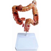 Anatomy and Physiology Study Tools Human Anatomy Model, 11 Life-Size 3D Colon Pathology Model, Digestive System Model Anatomy Study Tools, Science Classroom Must Haves