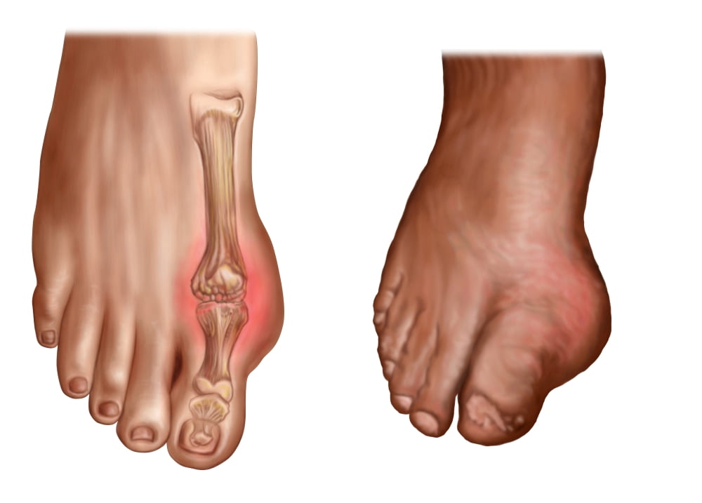 Anatomy of a swollen foot Canvas Art - Stocktrek Images (34 x 24)