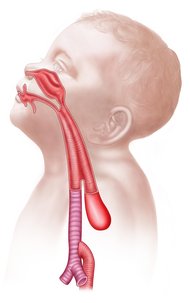 Anatomy of a tracheoesophageal fistula Canvas Art - Stocktrek Images (12 x 18)