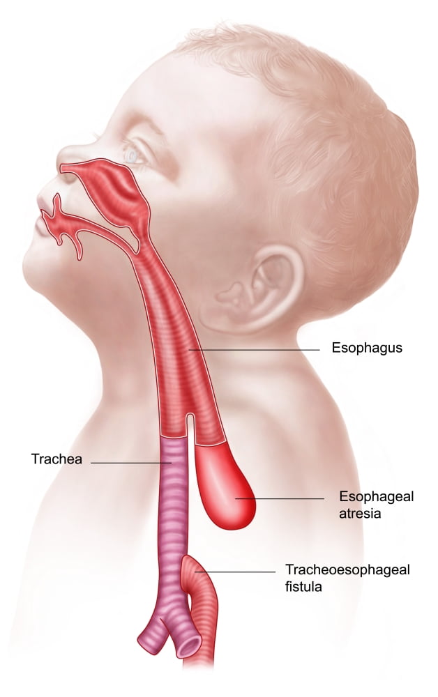Anatomy of a tracheoesophageal fistula Canvas Art - Stocktrek Images (23 x 36)