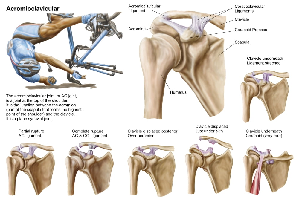 Anatomy of acromioclavicular joint rupture and displacement Canvas Art - Stocktrek Images (17 x 12)