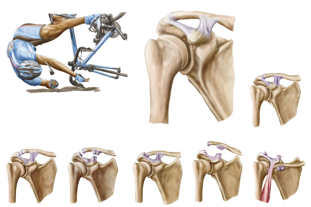 Anatomy of acromioclavicular joint rupture and displacement Canvas Art - Stocktrek Images (34 x 23)