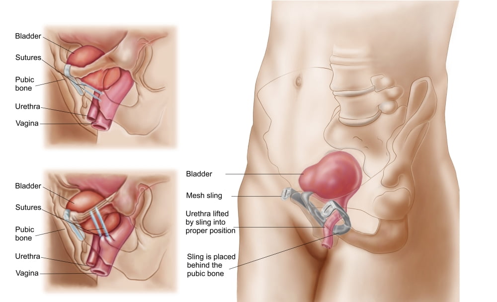 Anatomy of bladder suspension procedure for urinary incontinence Canvas Art - Stocktrek Images (36 x 22)