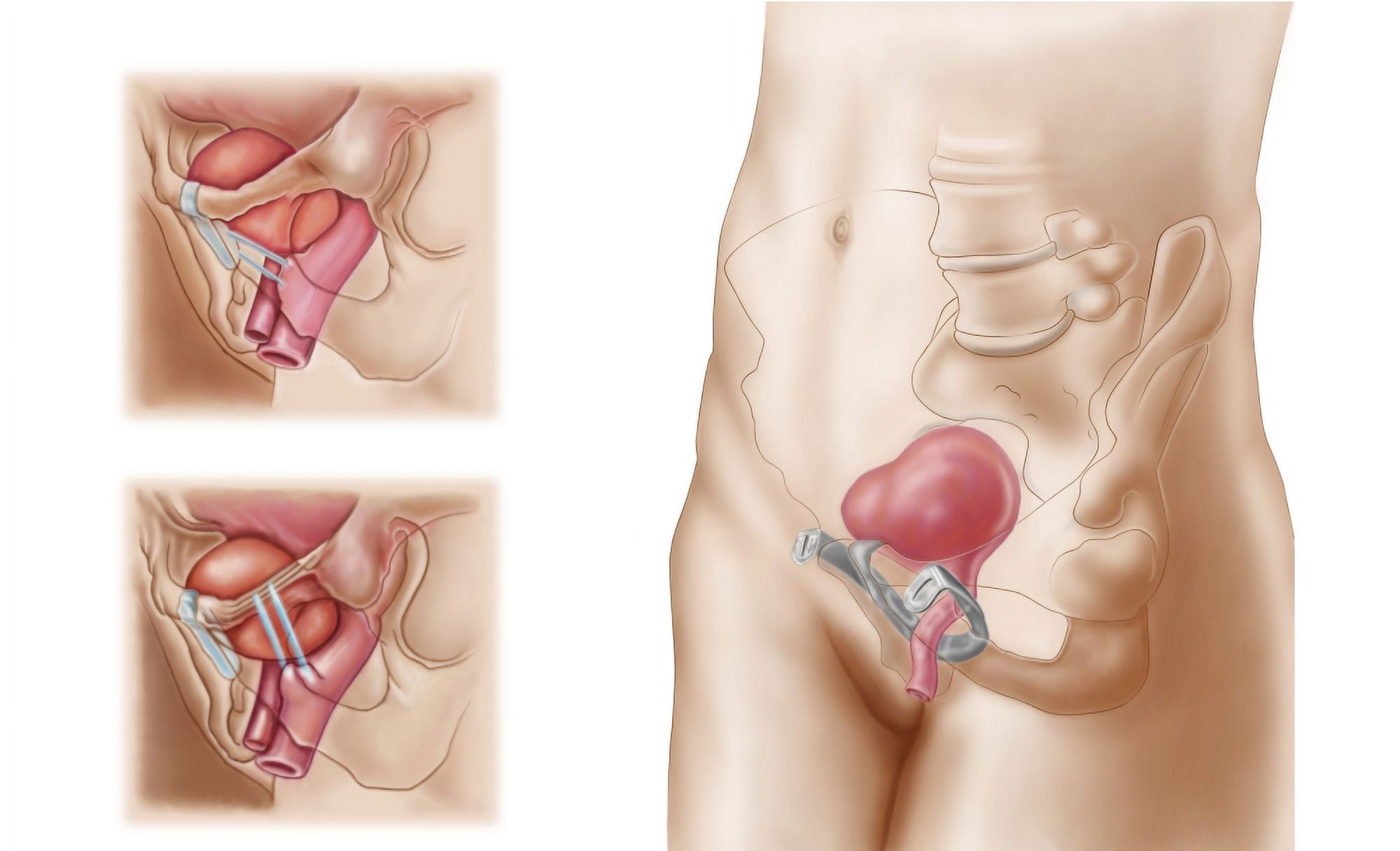 Anatomy of bladder suspension procedure for urinary incontinence Canvas Art - Stocktrek Images (36 x 22)