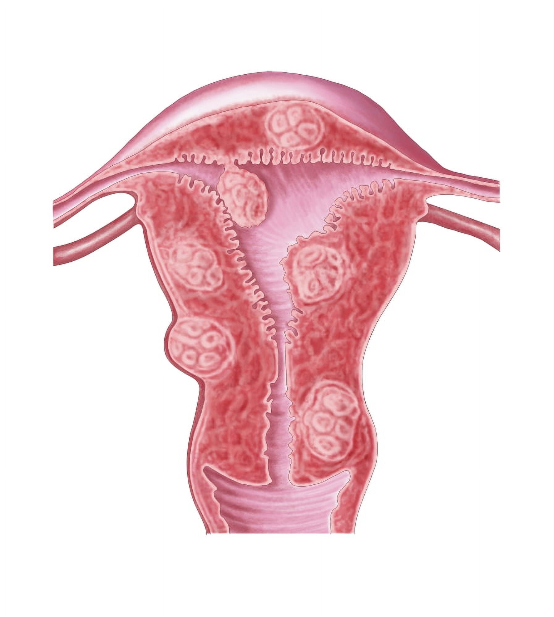 Anatomy of fibroid tumors in female uterus Canvas Art - Stocktrek Images (27 x 30)