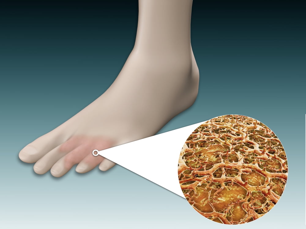 Anatomy of foot fungus with microscopic close-up Canvas Art - Stocktrek Images (17 x 13)