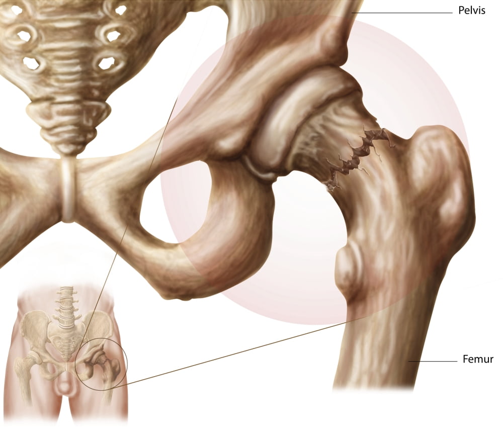 Anatomy of hip fracture Canvas Art - Stocktrek Images (15 x 13)