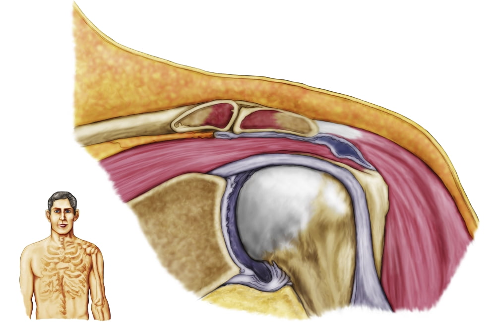 Anatomy of left shoulder coronal view Canvas Art - Stocktrek Images (17 x 12)