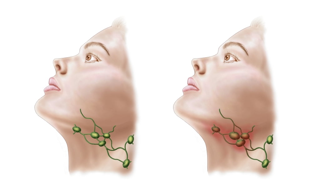 Anatomy of swollen lymph nodes Canvas Art - Stocktrek Images (18 x 12)