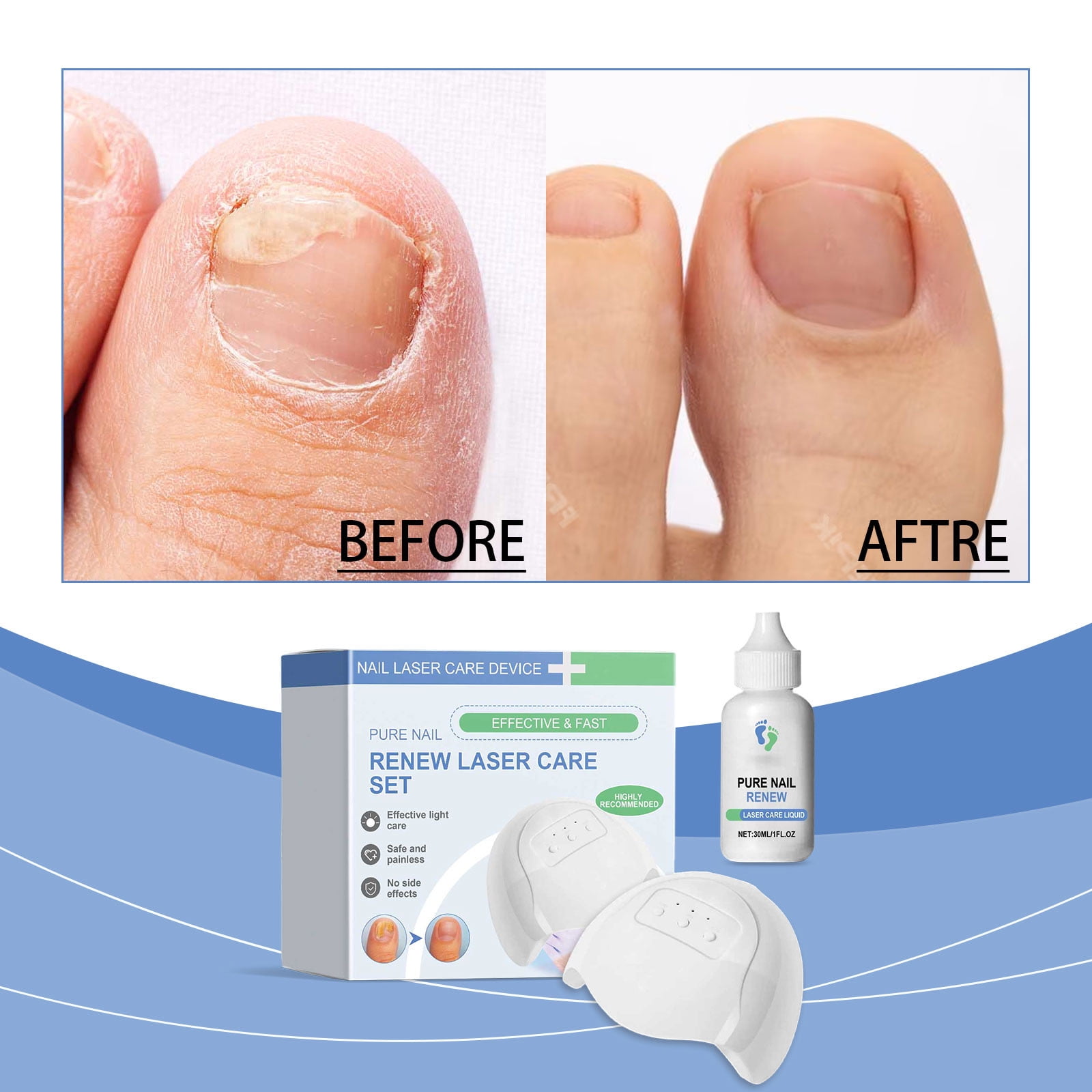Best At Home Toenail Fungus Laser Anti Fungal Nail Treatment Device, Anti Fungal Laser, Finger Toe Nail