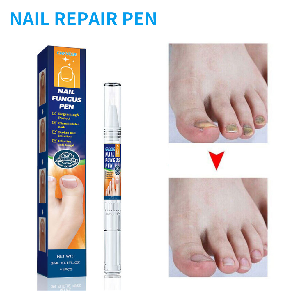 Antifungus Nail Repair Pen Thickening Nail Care Onychomycosis