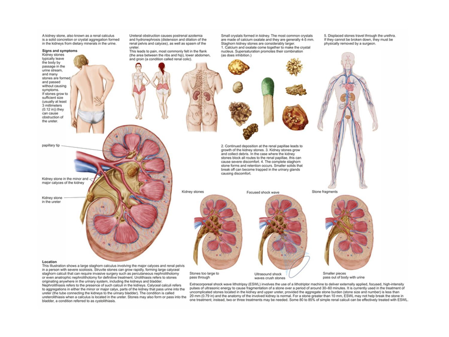 Medical Chart Showing the Signs and Symptoms of Kidney Stones