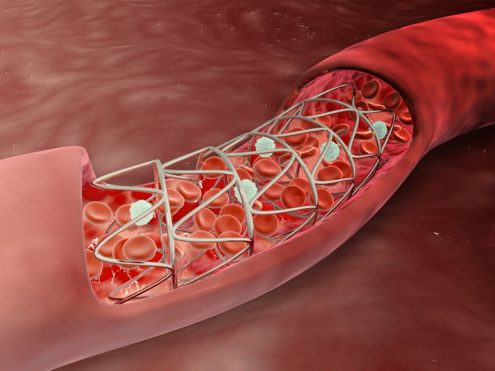 Artery cross-section with blood flow and stent deployment Canvas Art - Stocktrek Images (33 x 25)