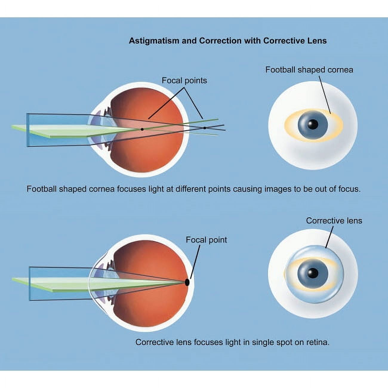Breathtaking Astigmatism Eye Correction Abstract in HD Breathtaking Astigmatism Eye Correction Abstract in HD