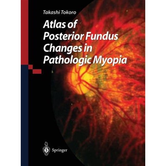 Pre-Owned Atlas of Posterior Fundus Changes in Pathologic Myopia (Paperback)