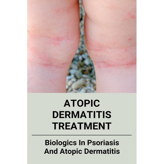 Atopic Dermatitis Treatment: Biologics In Psoriasis And Atopic Dermatitis: Cannabis For Health (Paperback)