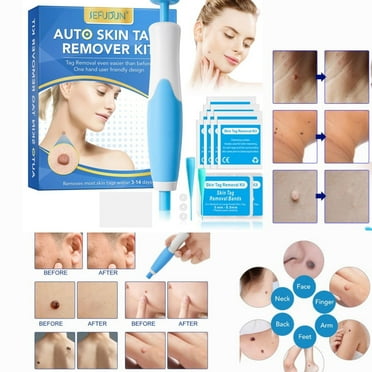 Auto Skin Tag Repair, 2-in-1 Auto Skin Tag Care Kit for Skin Tag, Painless Wart Repair for Most Body Parts