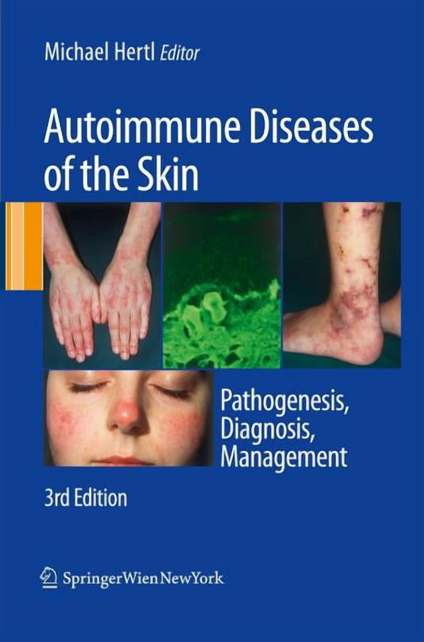 Autoimmune Diseases of the Skin: Pathogenesis, Diagnosis, Management ...