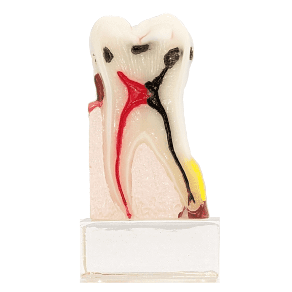 Axis Scientific Dental Model with Tooth Decay Scale - Enlarged 4 Times Life Size - Perfect for Dental Students, Dentists, Patient Consultation - Durable Clear Resin Base