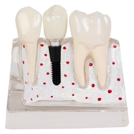Axis Scientific Enlarged Transparent Dental Implant Anatomy Model - Human anatomy system miniature, demonstration skill, educational model Includes Product Manual, scientific anatomy model