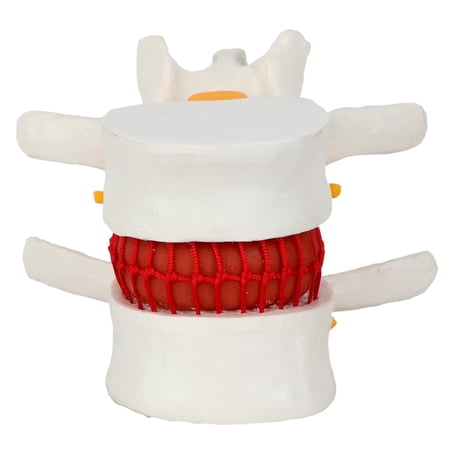 Axis Scientific Human Lumbar Herniating Disc Anatomy Model for Teaching and Learning