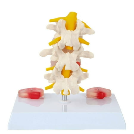 Axis Scientific Lumbar Vertebrae with Prolapsed Discs - Human anatomy system miniature, scientific anatomy model, demonstration skill educational model, Includes Product Manual