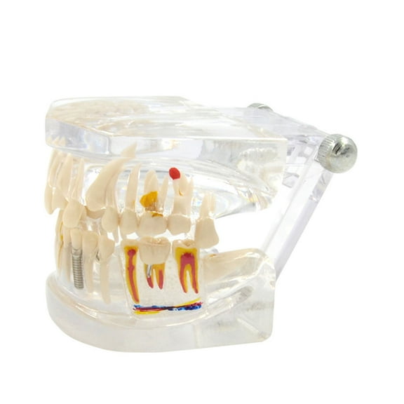 BQBQERT Clear Implant Teeth Model with Removable Teeth for Dentist Patient Communication Medical Lecture Use