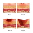 thumbnail image 1 of Bed Sores Poster Print by Monica Schroeder/Science Source (24 x 36), 1 of 1