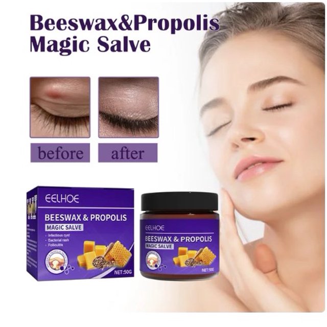 Beeswax and Propolis Magic Salve Hidradenitis suppurativa Boils and