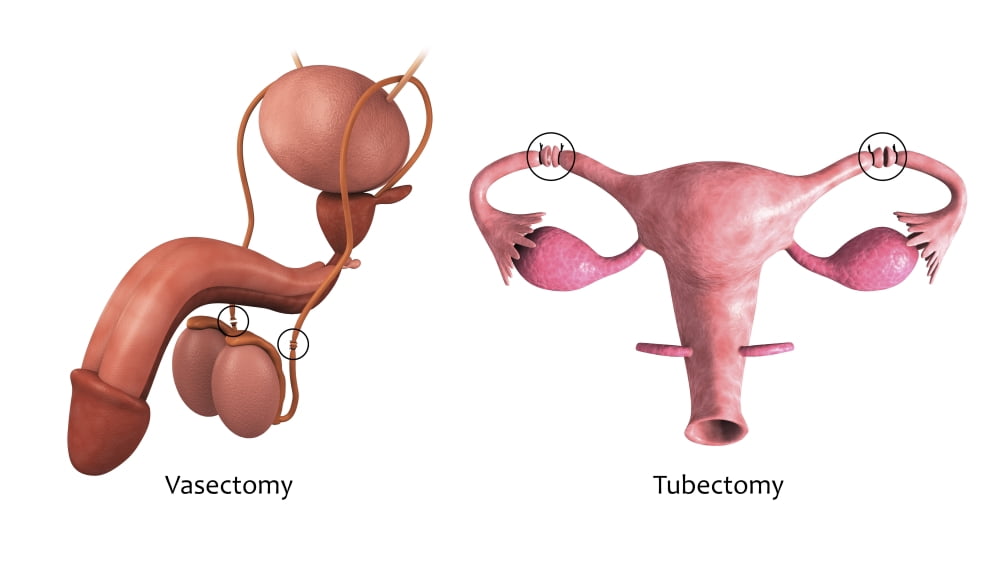 Biomedical illustration of a vasectomy and tubectomy Canvas Art - Stocktrek Images (38 x 22)