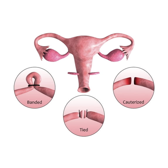 Biomedical illustration of a tubectomy. A tubectomy is when a woman's fallopian tubes are blocked to prevent implantation of eggs Poster Print (17 x 11)