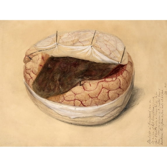 Blood Clot, Brain, Illustration 1869 Poster Print by Science Source (24 x 18)