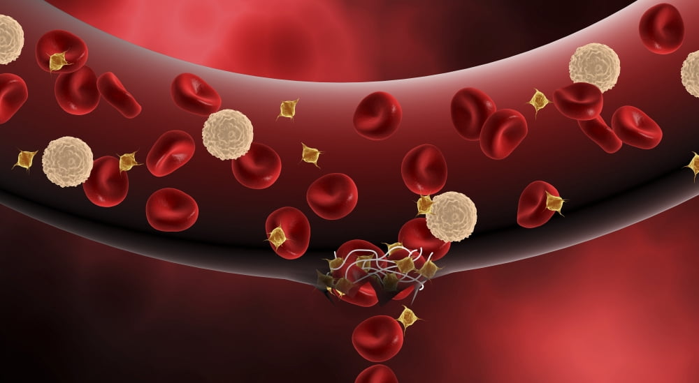Blood clotting inside artery Canvas Art - Stocktrek Images (20 x 11)